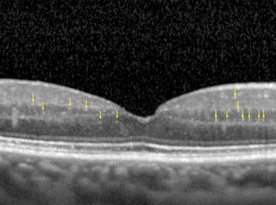 OCT Hyperreflective Retinal Foci in Diabetic Retinopathy: A Semi-Automatic Detection Comparative Study